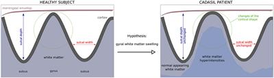 Alteration of the Cortex Shape as a Proxy of White Matter Swelling in Severe Cerebral Small Vessel Disease